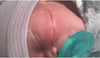 A caesarean section turns into a drama: when cutting the belly, the gynecologist cut the face of the newborn, 13 stitches, it is unacceptable